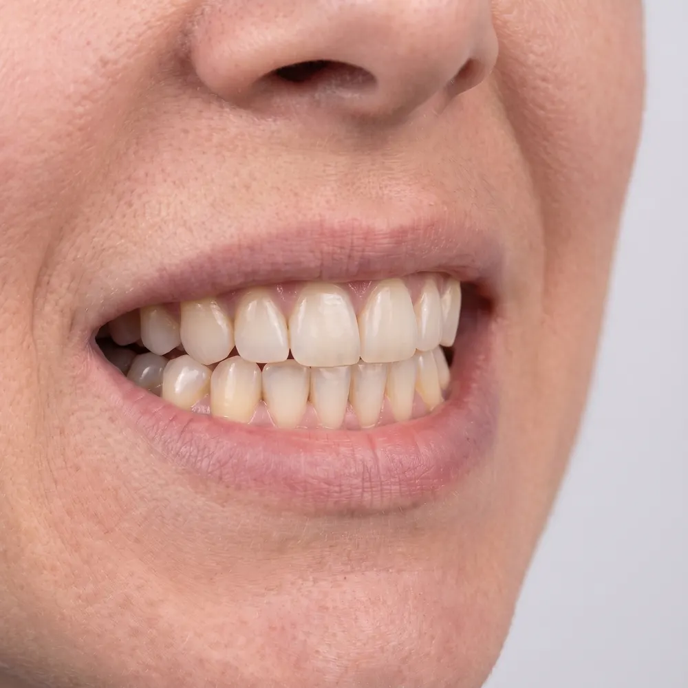 Close crop of a smile showing the front teeth before and after alignment and whitening — after