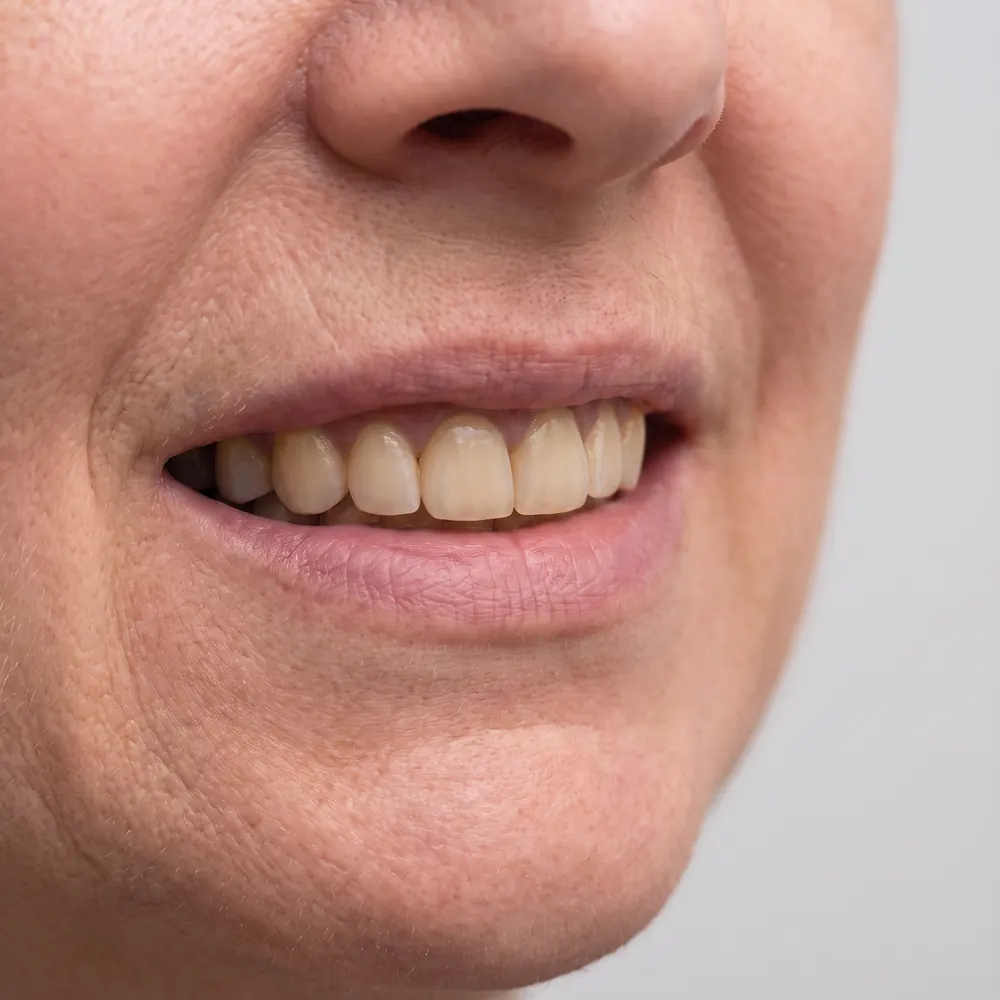 Close crop of a smile showing surface staining before and after cleaning and whitening — after