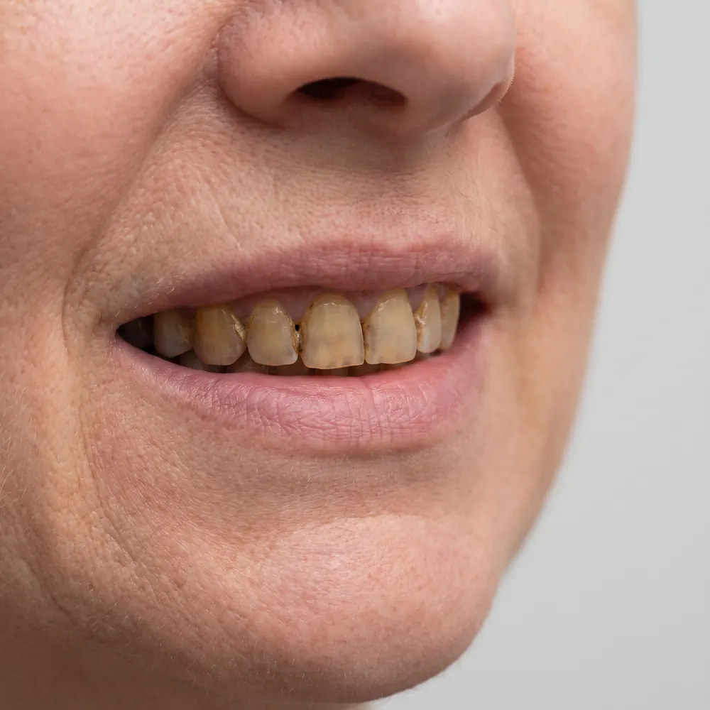 Close crop of a smile showing surface staining before and after cleaning and whitening — before